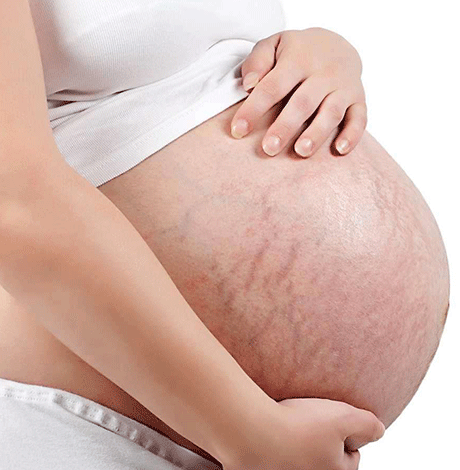 怀孕为什么会长妊娠纹 胖孕妈应警惕长妊娠纹