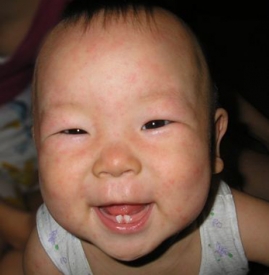 幼儿急疹症状 幼儿急疹有什么症状