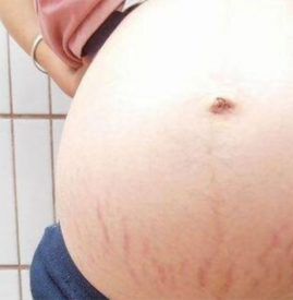 哪种人容易长妊娠纹 什么样人容易长妊娠纹