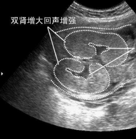 肾盂无分离是什么意思 双肾盂未见明显分离是什么意思