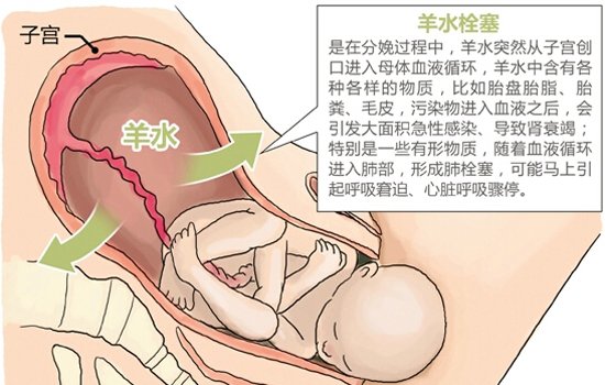羊水栓塞是怎么回事 警惕三类诱因导致的四类疾病