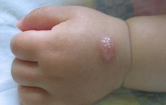 宝宝被蚊子咬了起水泡 过敏体质的孩子更容易起泡