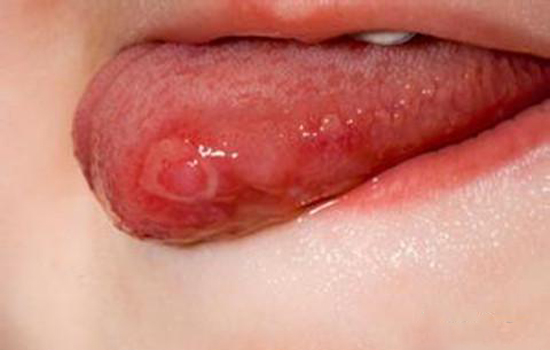 孕妇舌头溃疡怎么办 三类方法帮你远离溃疡