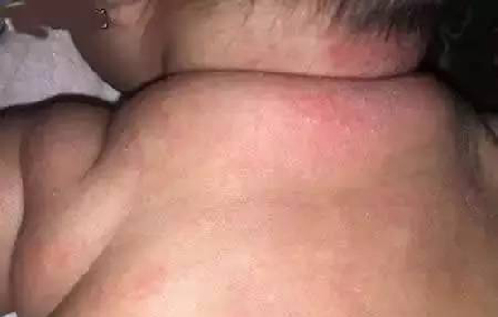 宝宝长疹子的大致判断 教你分辨常见的五种皮疹