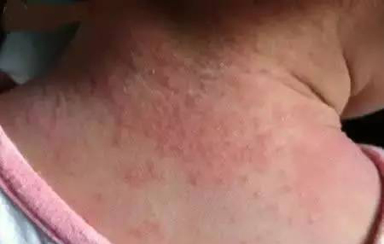 宝宝长疹子的大致判断 教你分辨常见的五种皮疹