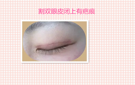 割双眼皮失败案例图片 看完你还敢割双眼皮吗