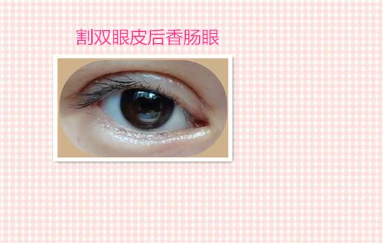 割双眼皮失败案例图片 看完你还敢割双眼皮吗