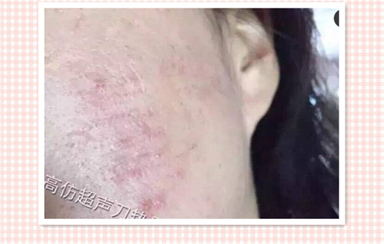 超声刀美容失败图片 超声刀让我毁容的真实例子