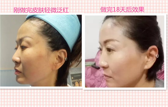 超声刀去皱纹效果怎么样 去皱纹保持时间与个人保养很有关系