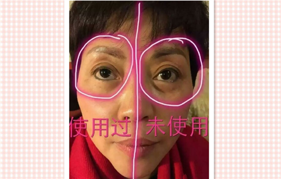 超声刀前后对比照片 6个真人经历告诉你超声刀有什么效果