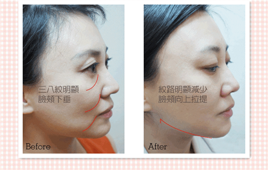 超声刀前后对比照片 6个真人经历告诉你超声刀有什么效果