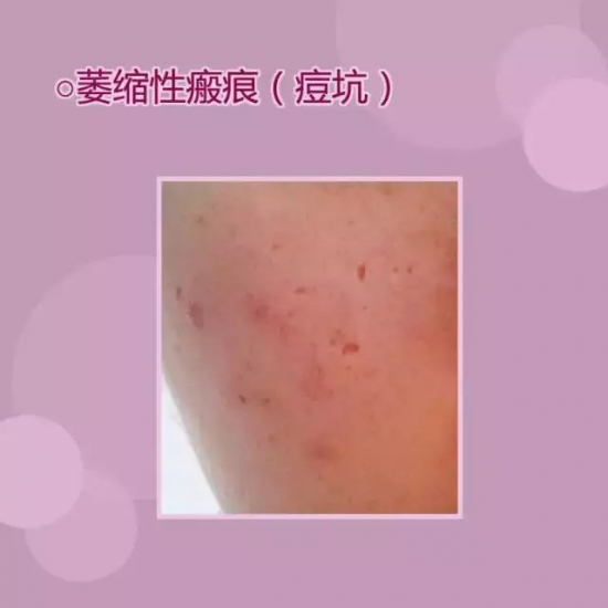 痘坑怎么修复 几种激光类型可以解决