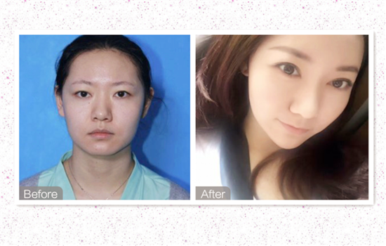 热玛吉效果图 Thermage美容效果重在选择医生和仪器