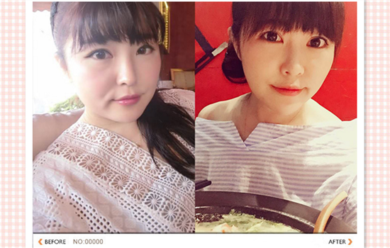 电波拉皮手术好吗 拯救松垮脸型的无创美容法