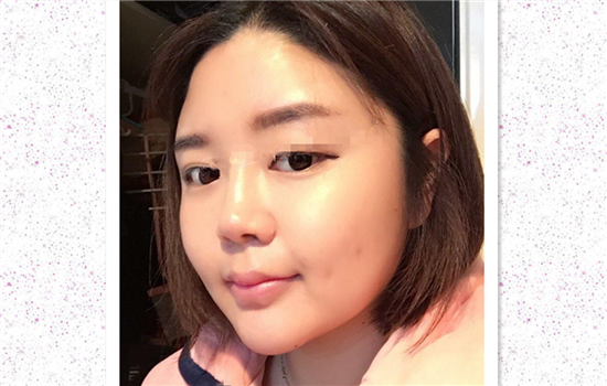 面部吸脂真实案例 真实日记记录手术后感受