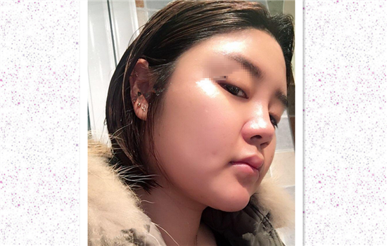 面部吸脂真实案例 真实日记记录手术后感受