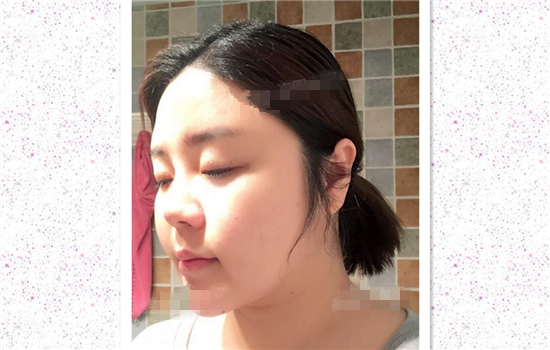 面部吸脂真实案例 真实日记记录手术后感受