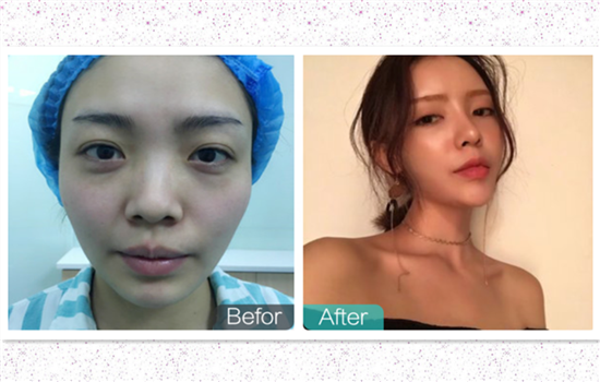 硅胶隆鼻的图片 真人整形前后对比让你见识硅胶鼻效果