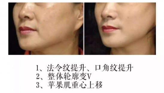 怎么变V字脸  变美变年轻变V脸的秘诀