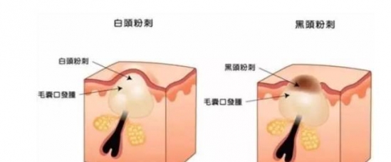 怎么解决毛孔粗大的问题  怎么缩小毛孔