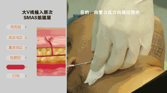 怎么变V字脸  变美变年轻变V脸的秘诀