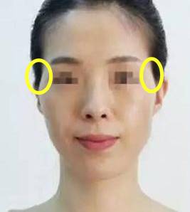 脸部有凹陷怎么办 脸部凹陷的治疗方法