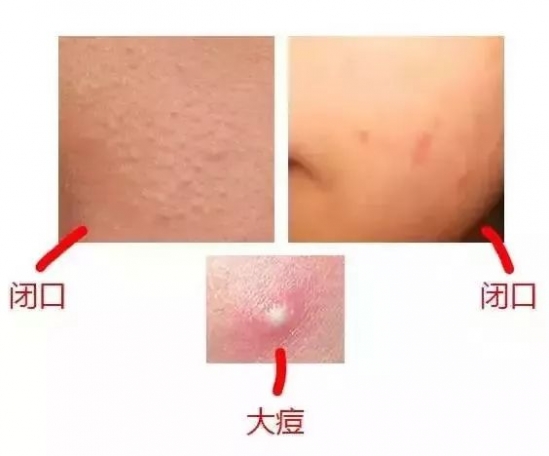 脸上的闭口怎么处理 注意这几点还你天然好肌肤