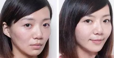 脸部有凹陷怎么办 脸部凹陷的治疗方法
