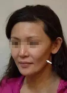 脸部有凹陷怎么办 脸部凹陷的治疗方法