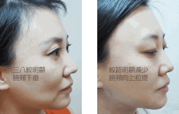 怎么变V字脸  变美变年轻变V脸的秘诀