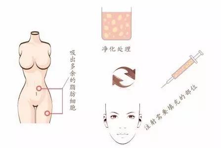 脸部有凹陷怎么办 脸部凹陷的治疗方法