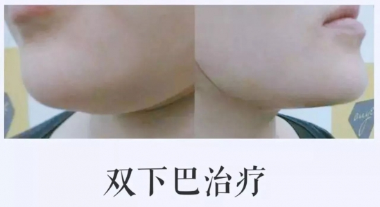 怎么变V字脸  变美变年轻变V脸的秘诀