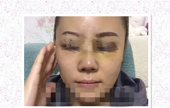 鼻修复失败案例 爱美者术前谨慎择医才能避免