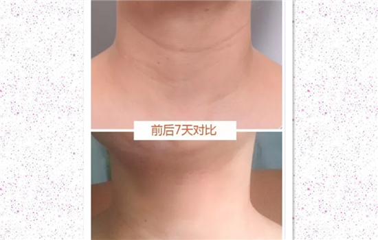 嗨体水光针有什么功效 没想到嗨体竟然这样神奇