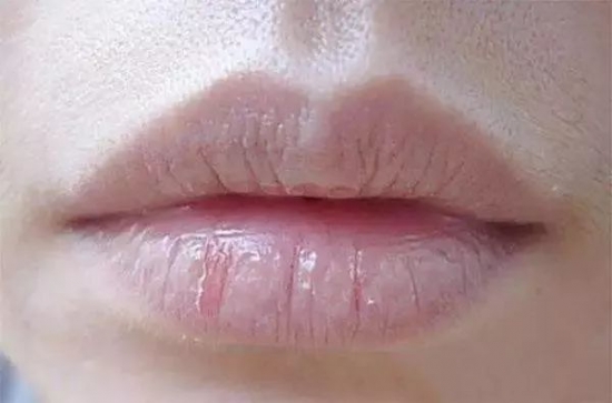 嘴唇干裂脱皮怎么办  哪个男神会愿意壁咚嘴唇起皮的你呢
