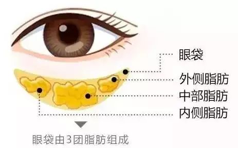 眼袋的危害   眼袋不消还谈什么美丽不美丽的