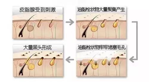 去黑头的最好方法 七个去黑头小妙招介绍
