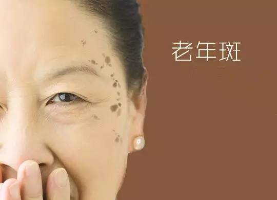各种斑的形成原因 祛斑难那是你不了解长斑的原因