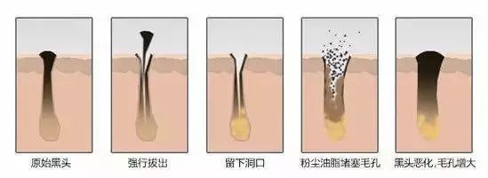 去黑头的最好方法 七个去黑头小妙招介绍