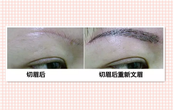 切眉能保持几年 3个步骤保证切眉的永久效果