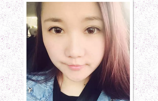 全切双眼皮加开眼角多久恢复 达人亲历有图有真相
