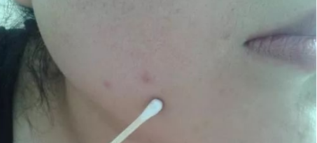 维a酸软膏真的去痘吗 关于维a酸软膏祛痘原理分析