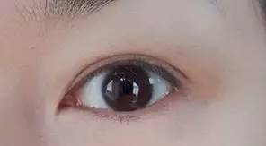 双眼皮手术恢复过程 割双眼皮，为什么你恢复的比别人慢？