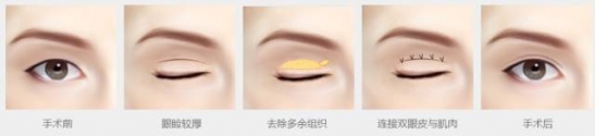 双眼皮手术恢复过程 割双眼皮，为什么你恢复的比别人慢？