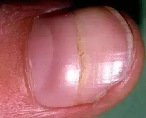 指甲裂了怎么办 出现这种情况，竟是身体在求救！
