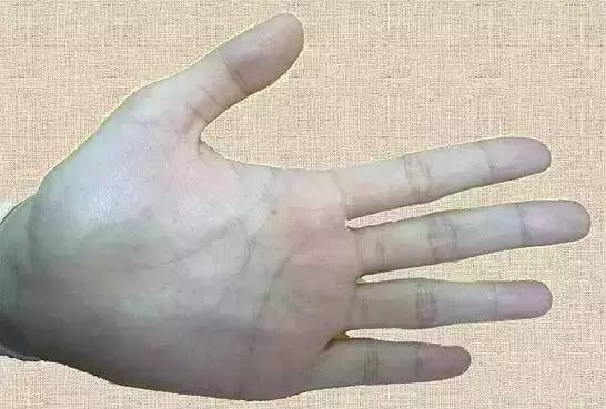 身体青筋明显咋回事 这个部位青筋暴突要注意