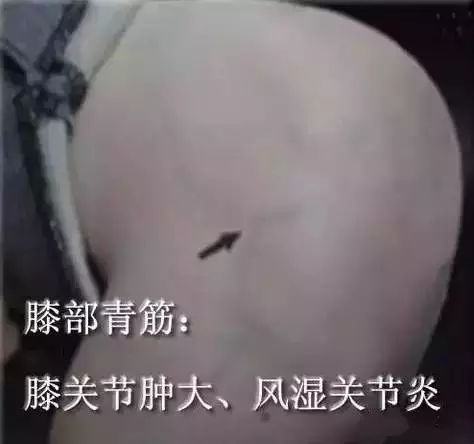 身体青筋明显咋回事 这个部位青筋暴突要注意