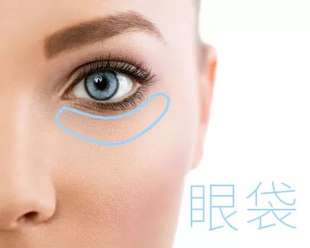 怎么样祛除眼袋 有2个手术方法