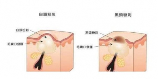 怎么去闭口粉刺 去闭口粉刺究极大法