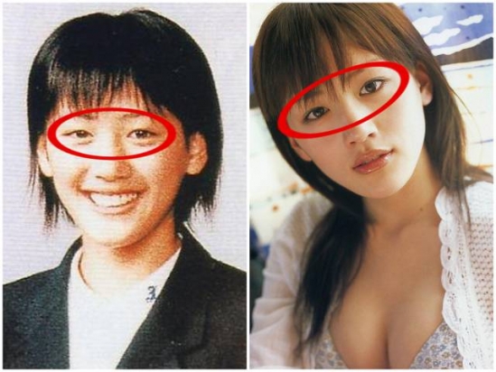 眼睑下至术是什么
